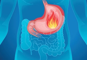 Come Sfiammare la Mucosa dello Stomaco: Rimedi, Trattamenti e Prevenzione