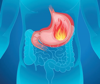 Come Sfiammare la Mucosa dello Stomaco: Rimedi, Trattamenti e Prevenzione